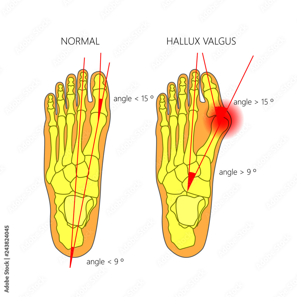 Illustration Of The Normal Foot And Hallux Valgus With Indicating Of illustration-of-the-normal-foot-and-hallux-valgus-with-indicating-of