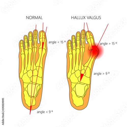Illustration of the normal foot and hallux valgus with indicating of the first metatarsophalangeal and the first-second intermetatarsal angles