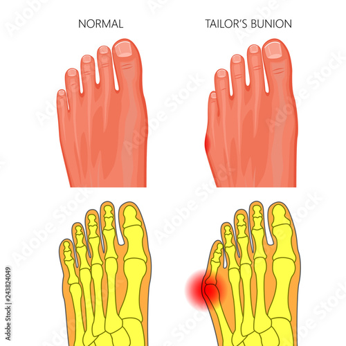 Illustration of the normal foot and Tailor's bunion. External and skeletal views.  Used: gradient, transparency
