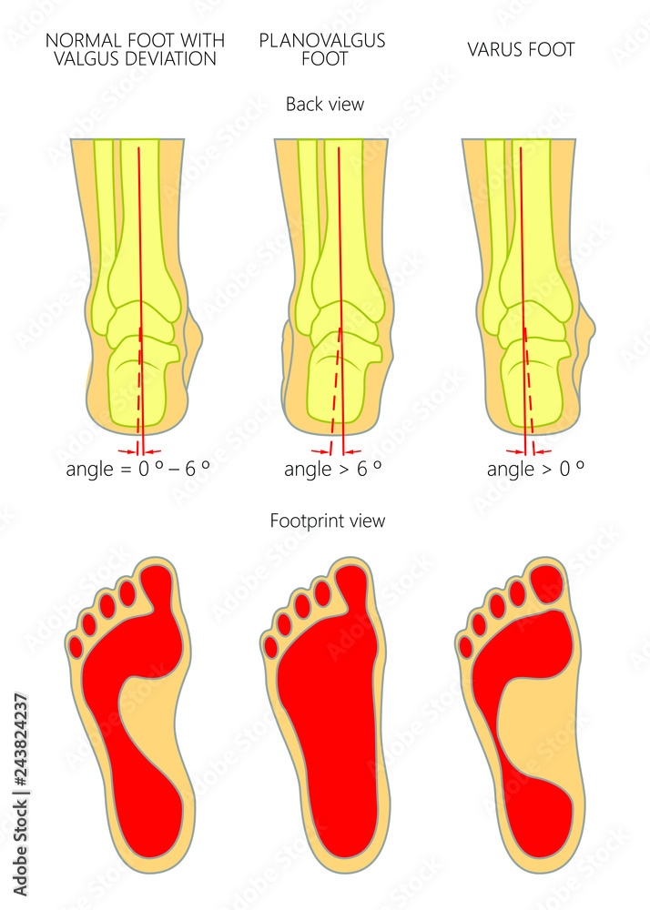 Planovalgus foot cheap