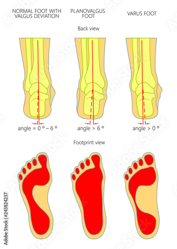 Illustration of normal,  Planovalgus and varus  feet with footprint.