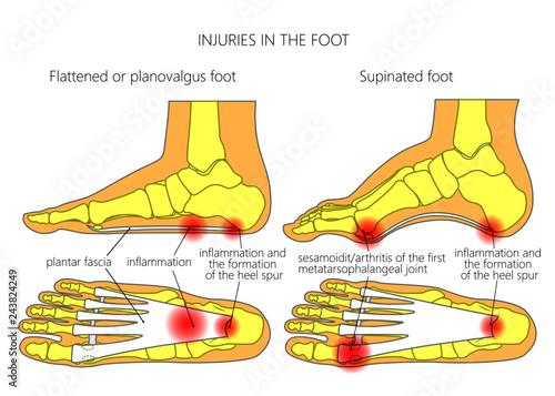 Injuries in the foot: plantar fasciitis, heel spur and sesamoidit