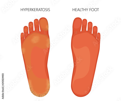 Illustration of Plantar Hyperkeratosis of the foot with dry sole skin and cracked heel.