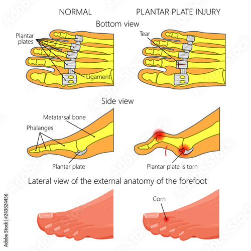 Vector illustration (diagram). Hammer toe. Plantar plate injury. Mechanism of rupture of plantar plate of the second toe of the foot. External and skeletal views of an ankle.