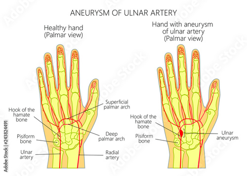 A schematic illustration of post-traumatic ulnar artery aneurysm located adjacent to the hamate bone.