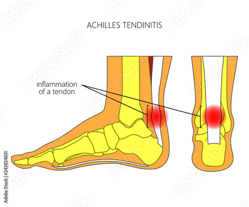 Illustration of Skeletal ankle (side view and back view) with tendinitis of Achilles tendon