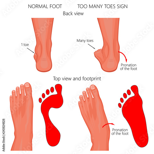 Vector illustration of the normal human foot and the foot with pronation or flatfoot, with hindfoot deformity. Too many toes sign.