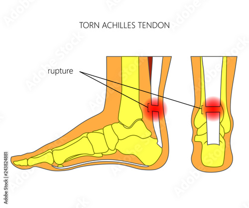 Illustration of Skeletal ankle (side view and back view) with torn Achilles tendon