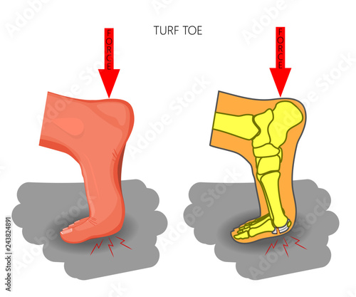 Vector illustration (diagram).Turf toe. Sport trauma. Mechanism of rupture of plantar plate of the first toe of the foot. External and skeletal views of an ankle.