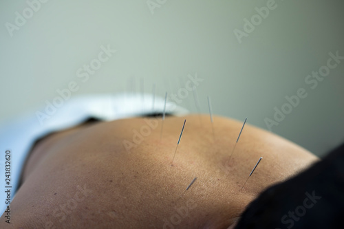 traditional acupuncture treatment