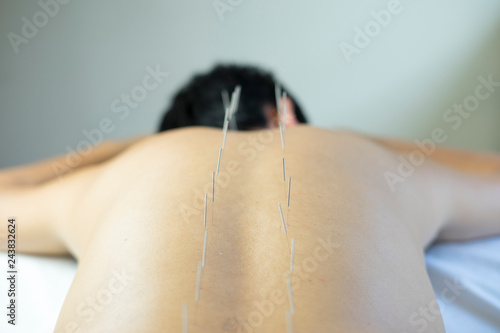 traditional acupuncture treatment