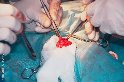 Bladder. Removal of the tumor (concept Surgery)