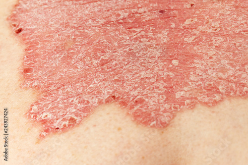 Detail of psoriatic skin disease Psoriasis Vulgaris with narrow focus, skin patches are typically red, itchy, and scaly