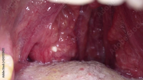 Close-up. Man's red throat. Purulent tonsillitis photo
