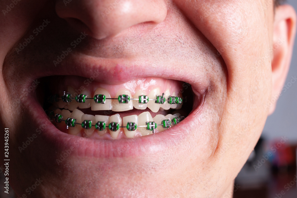 Portrait of a man with crooked teeth and metal braces with green rubber  bands close-up. Young man with dental orthodontic braces Stock Photo |  Adobe Stock