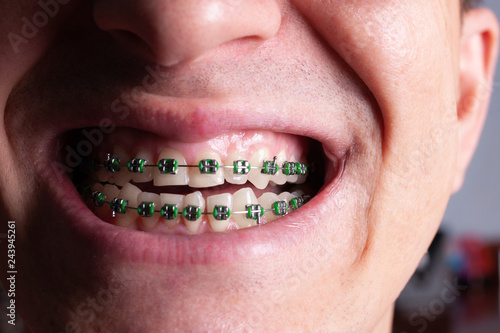 Portrait of a man with crooked teeth and metal braces with green rubber bands close-up. Young man with dental orthodontic braces