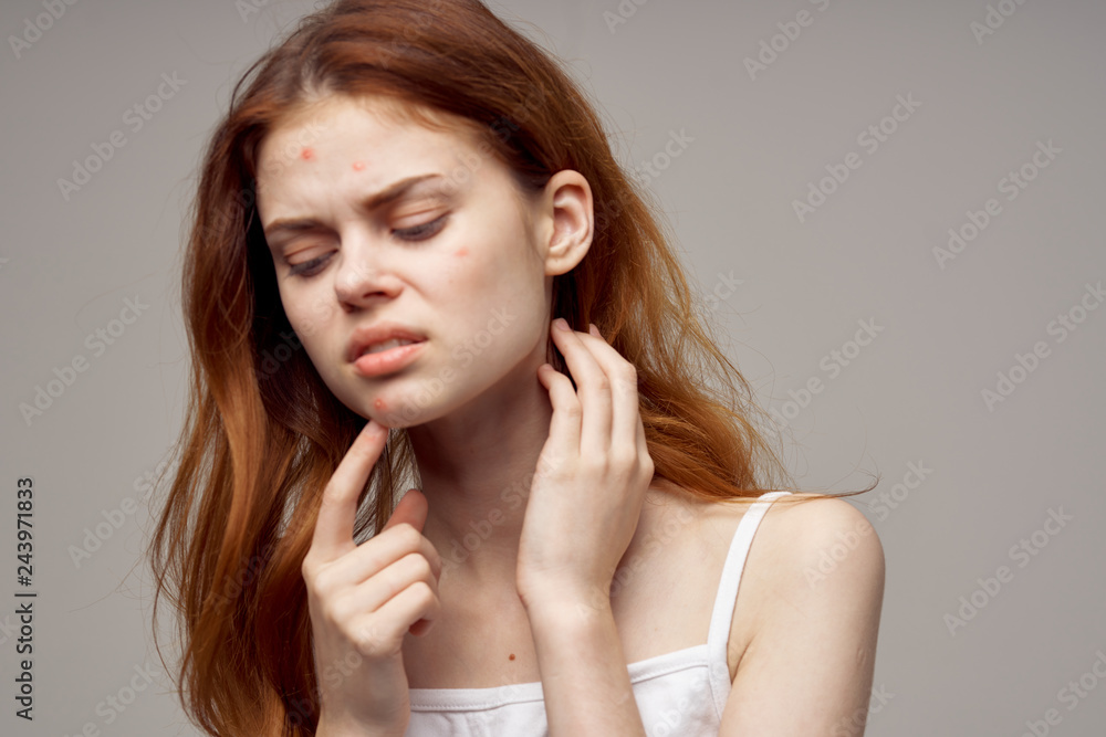 woman with acne