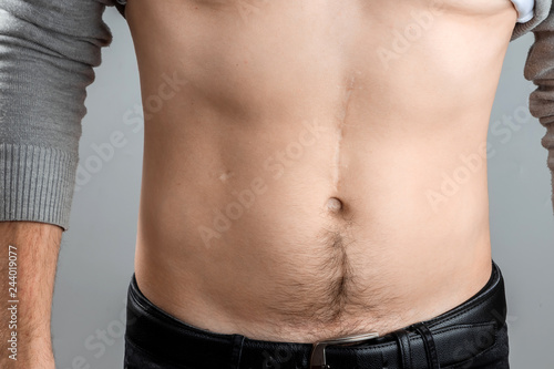 scars removal concept, large scar after surgery on the abdomen young man, blurred neutral background, selective focus photo