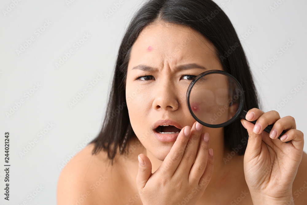 Portrait of young Asian woman with acne problem and magnifier on white background Portrait of young Asian woman with acne problem and magnifier on white background