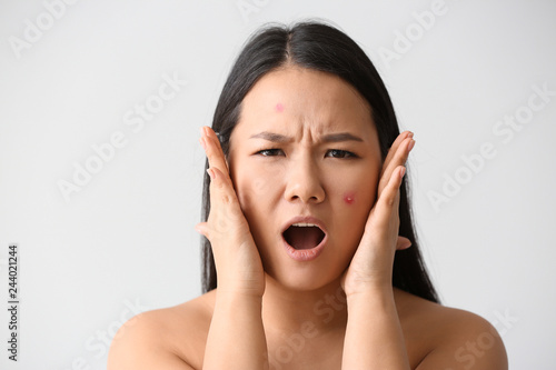 Portrait of stressed Asian woman with acne problem on white background