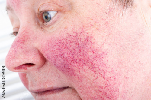 Portrait of unhappy elderly woman suffering skin disease rosacea with no make-up