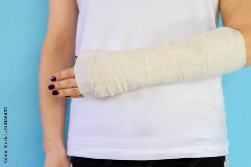 Woman with broken arm bone in cast, plastered hand on blue background.