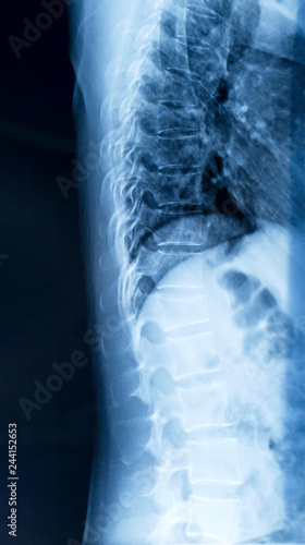 Film x-ray human's chest and spine in side view