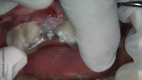 installation of a surgical template for single implantation of the front tooth cutter