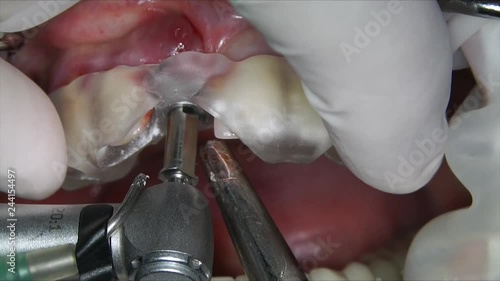 preparation for implanting the front tooth using a surgical template