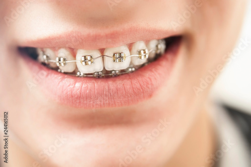 Fotografia The look is close to the teeth's braces on the teeth of boy to equalize the teet