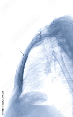 Bilde på lerret Sternum Lateral view show fracture of sternum in trauma case ( arrow head )