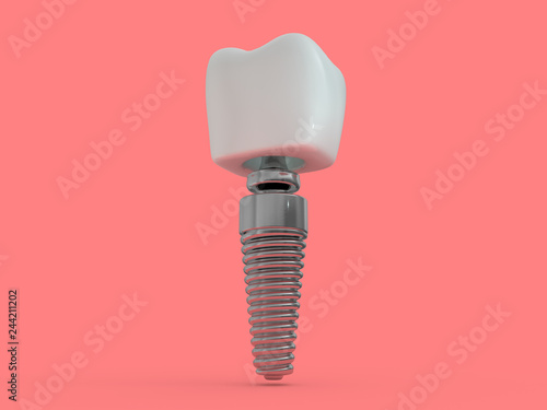 Dental implant dentist, tooth layout, plastics, man, teeth, treatment. 3D