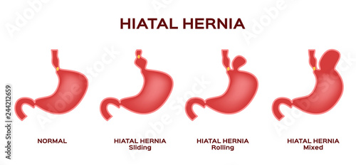 Hiatal hernia / stomach vector photo