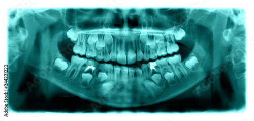 Panoramic radiograph is a scanning dental X-ray of the upper jaw maxilla and lower jawbone mandible a child aged 7 seven years.