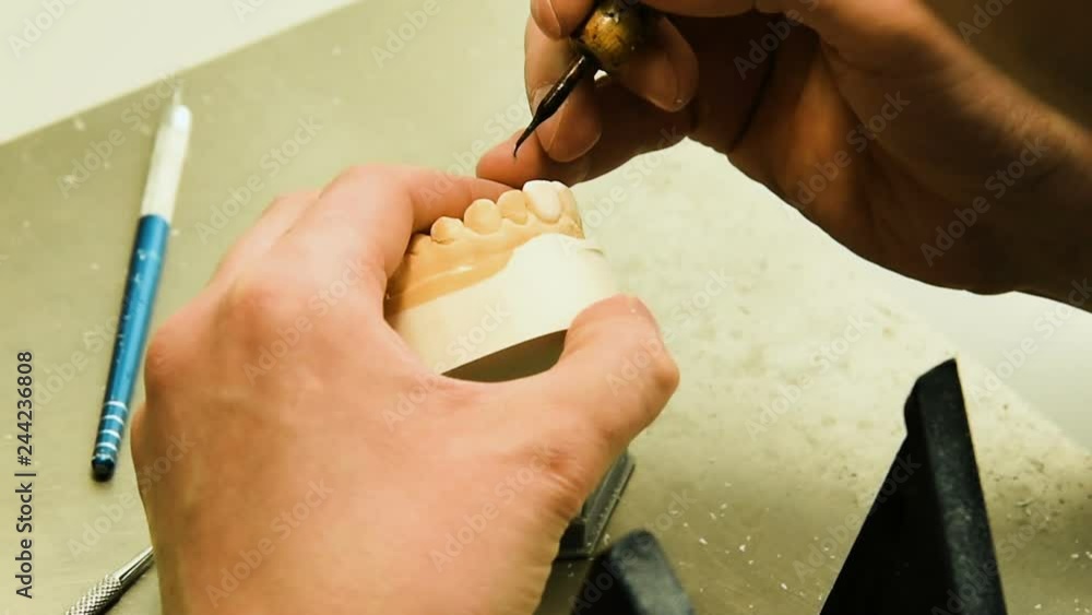 Dentist makes a dental implant prosthesis made of plaster cast