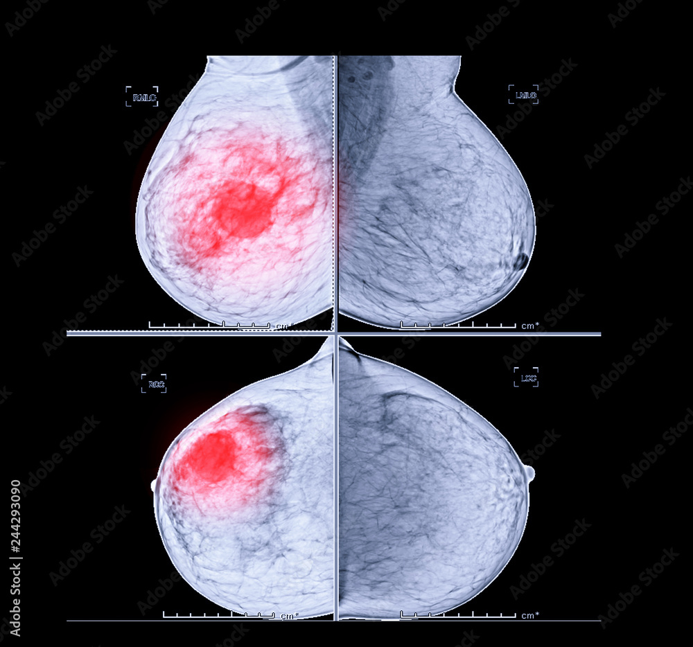 X Ray Digital Mammogram Both Side Cc View And Mlo Mammography Or