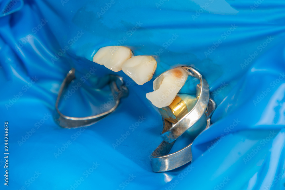 two chewing side teeth of the upper jaw after treatment of caries
