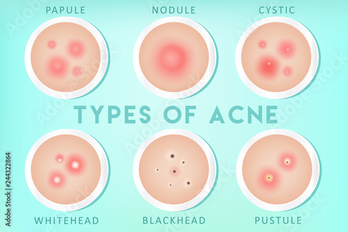 Acne types: whiteheads, blackheads, pustules, papules, cysts, nodules