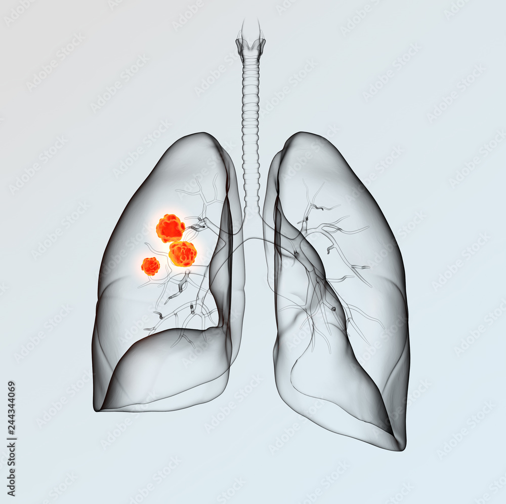 новообразование в легких. лёгкие человека рисунки. легкие человека мультяшные картинки. рисунки людей легкие. рак(опухоль) вектор.