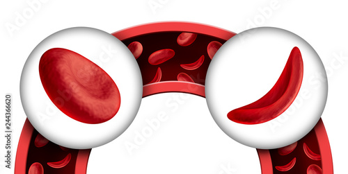 Sickle Cell Disease photo
