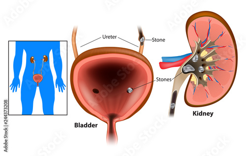 Nephrolithiasis kidney stones disease or urolithiasis. Renal Calculus or Stones blocking the urinary tract. photo