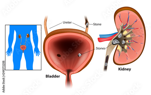 Nephrolithiasis kidney stones disease or urolithiasis. Renal Calculus or Stones blocking the urinary tract.