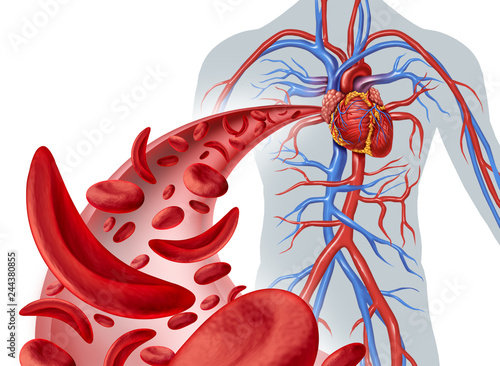 Fényképezés Sickle Cell Heart Circulation