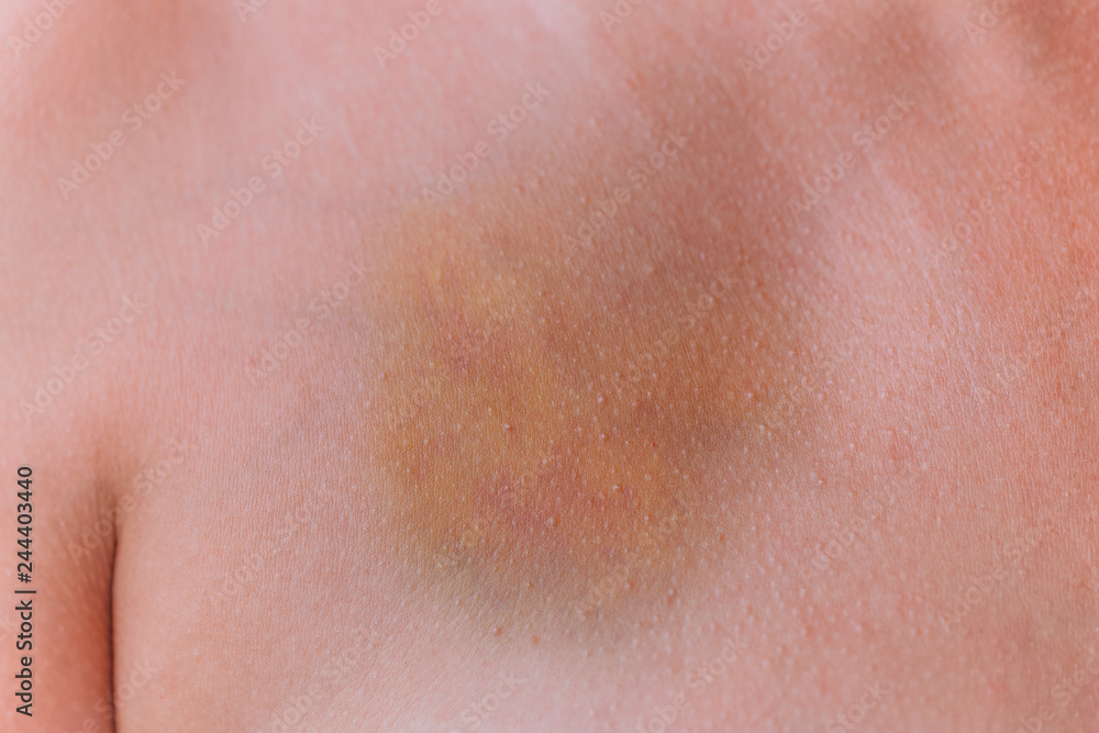 Closeup view of real huge yellow, red and blue bruise at female breast. Horizontal color photography.
