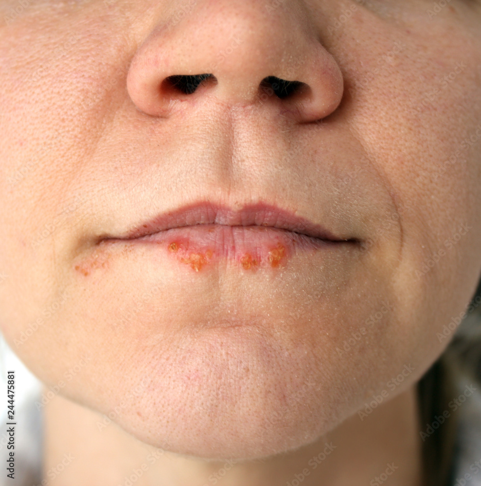 Fototapeta premium Cold sores