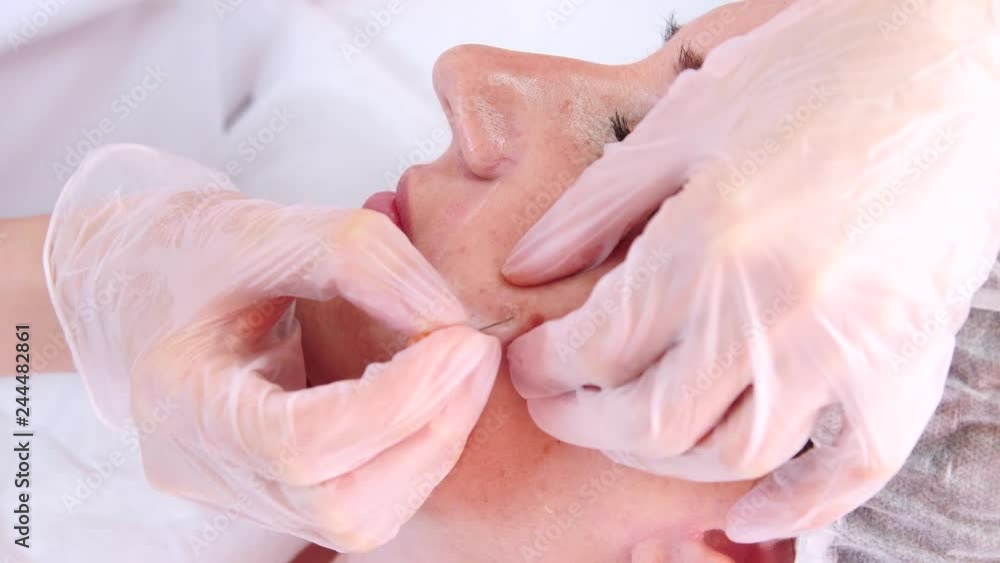 Doctor inserts needle into patient face, leaving drop of blood Doctor inserts needle into patient face, leaving drop of blood