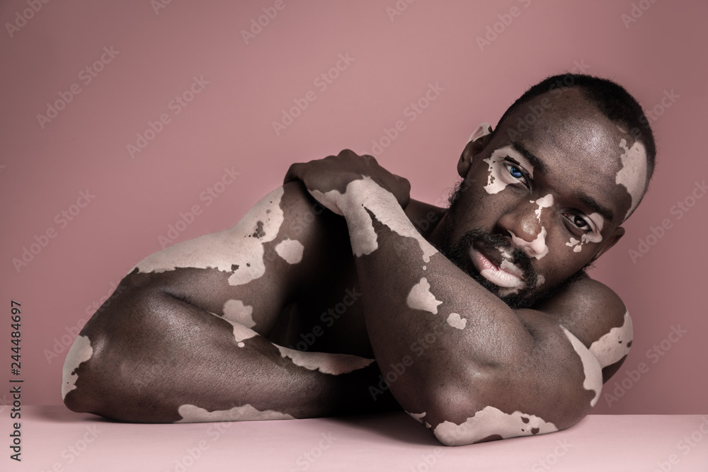 Naklejka premium Close up fashion portrait of a male afro or african model with white pigmentation. Concept of no racism. Conceptual image of young man at pink studio background