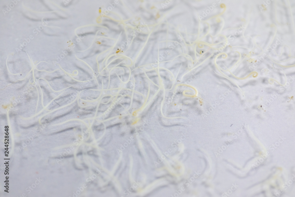 Ascariasis is a disease caused by the parasitic roundworm Ascaris ...
