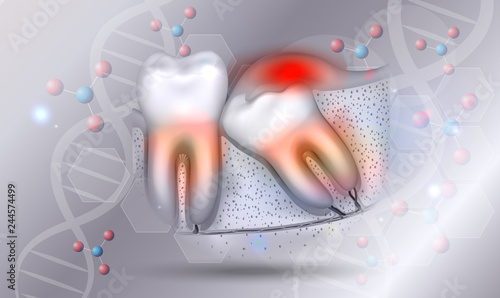 Wisdom tooth eruption inflamed gums illustrated anatomy on a beautiful abstract scientific background