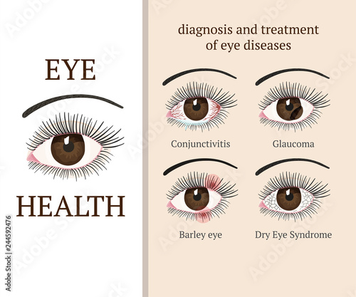 Most common eye problems.